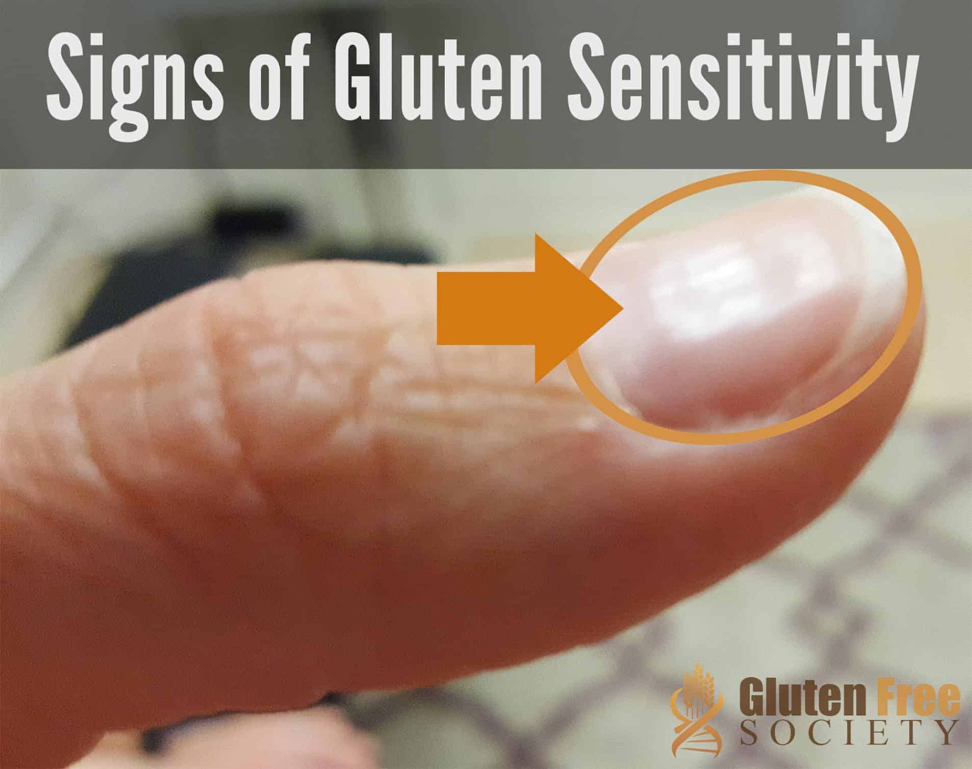 gluten-sensitivity-and-iron-deficiency-anemia