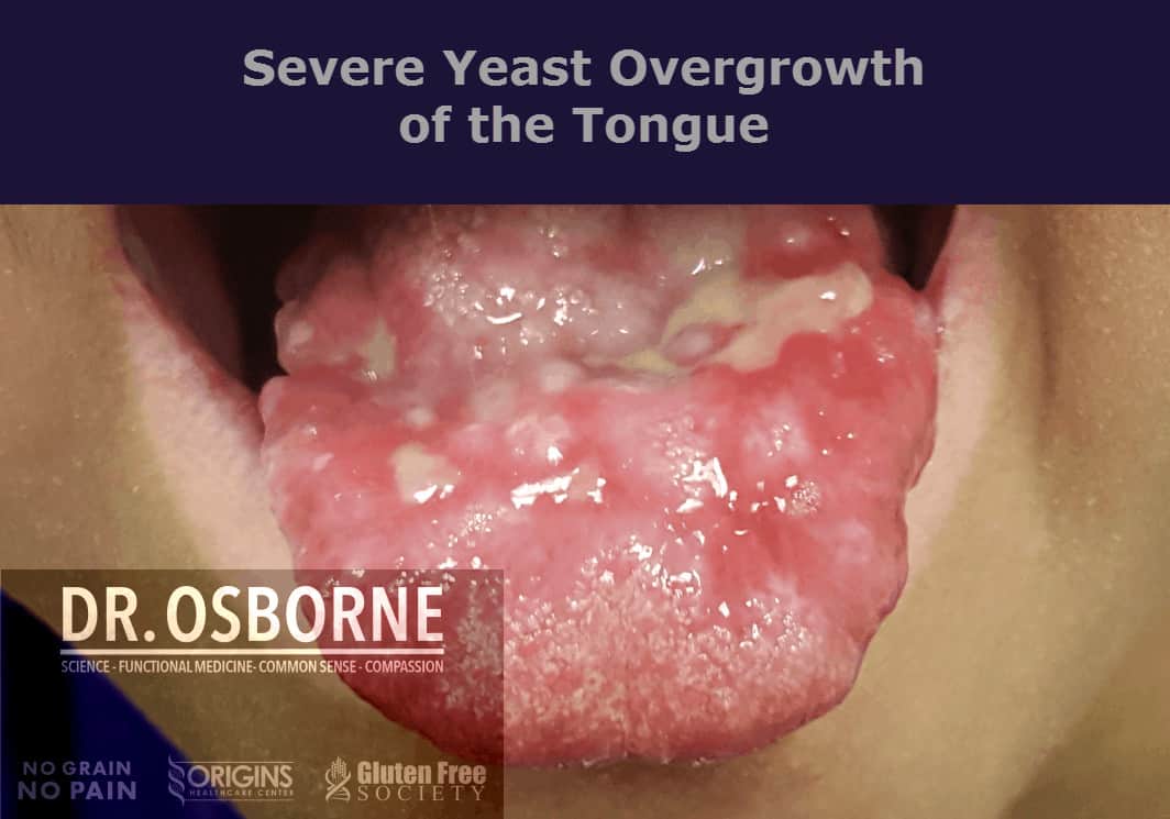 Candida Infection Tongue - Dr. Osborne