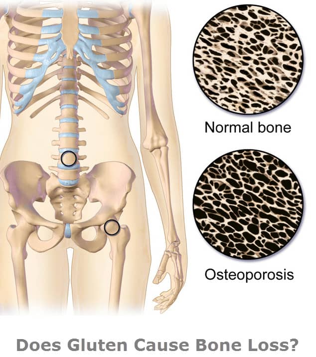 Is gluten one of the causes of osteoporosis