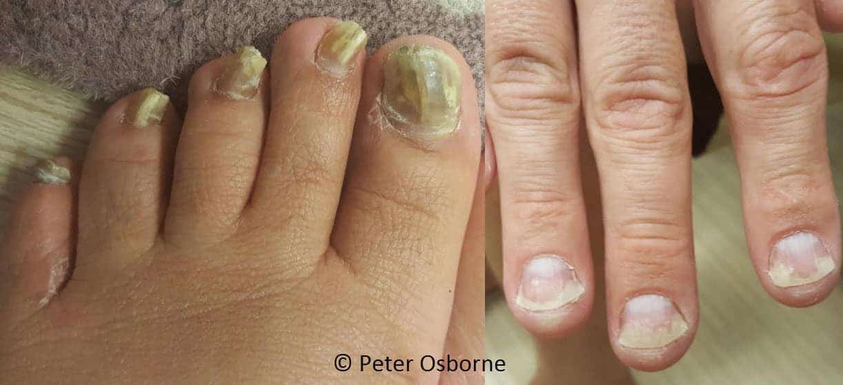 yeast in the nails