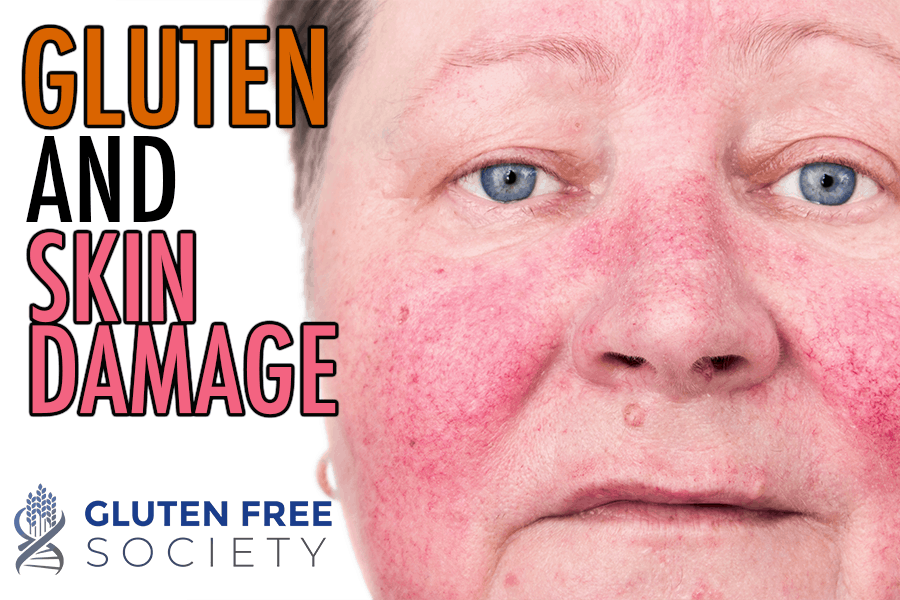 Dermatitis Herpetiformis Gluten Free Society