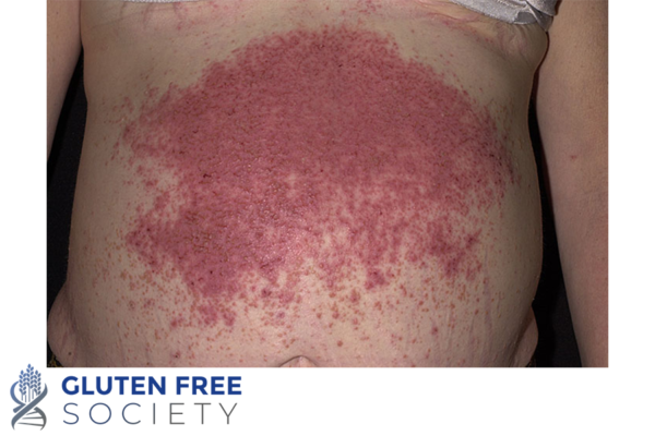 Can gluten cause skin problems gluten free society