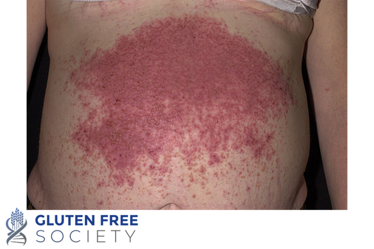Can Gluten Cause Skin Problems? GlutenFree Society