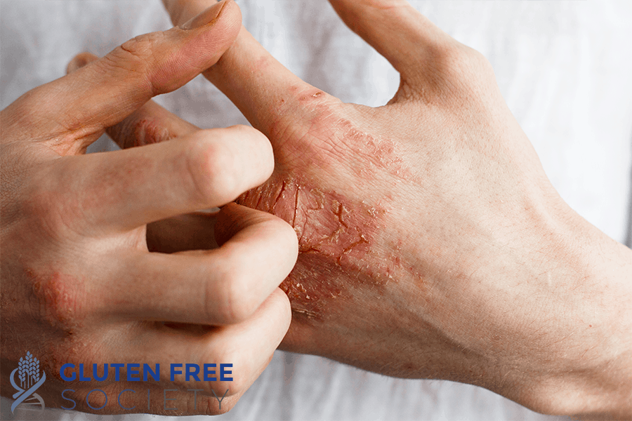 gluten and eczema