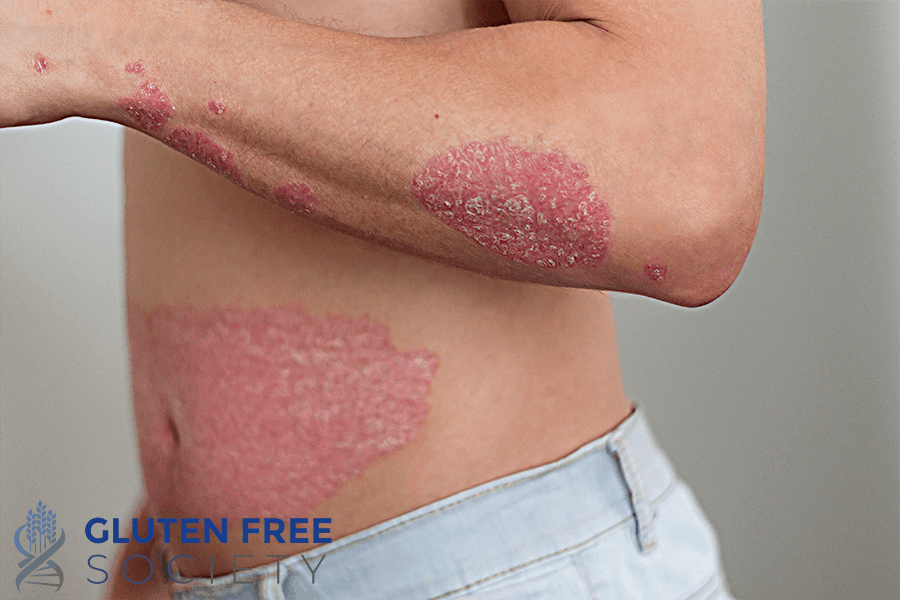 gluten and psoriasis