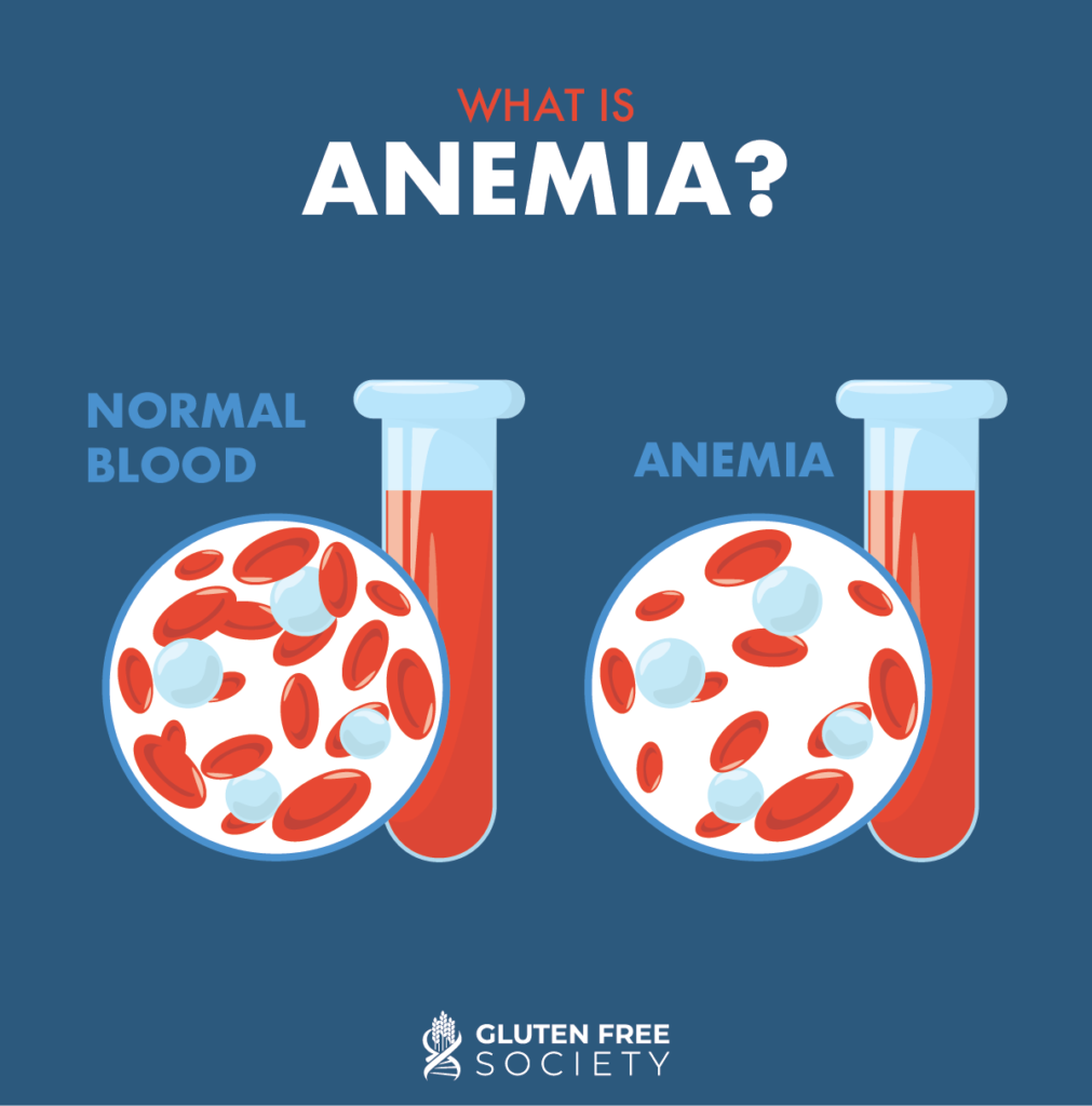 Can Gluten Cause Anemia? Gluten Free Society