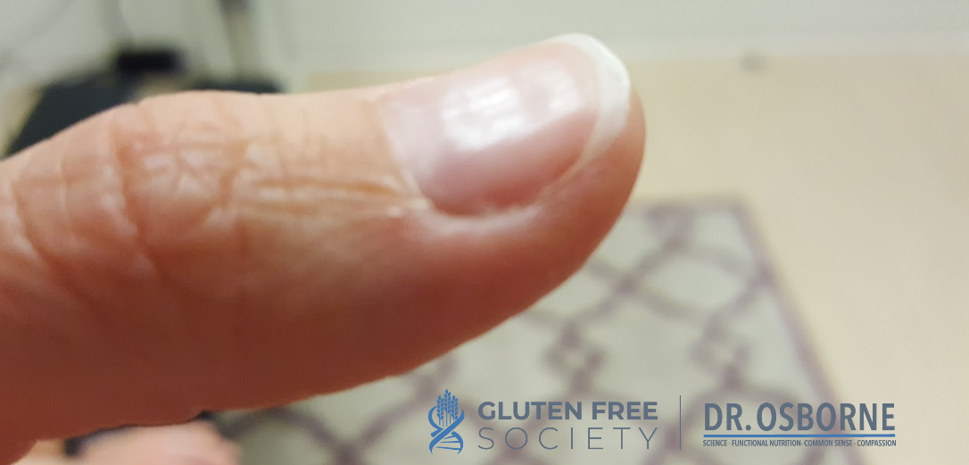 iron deficiency symptoms nail spooning