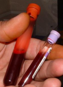Antibody blood tests for gluten sensitivity are inaccurate