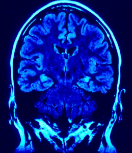 Brain Gluten and Seizures