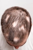  gluten and hair loss