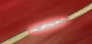 Nerve damage and gluten